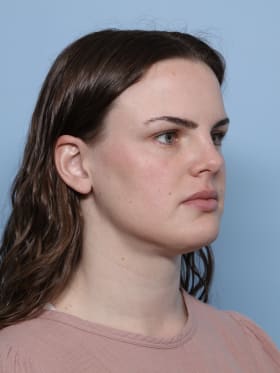 Buccal Fat Removal after - oblique right
