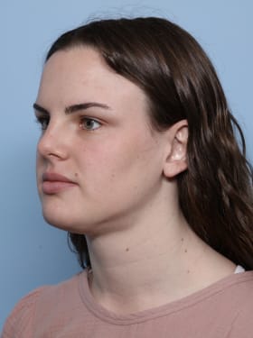 Buccal Fat Removal after - oblique left