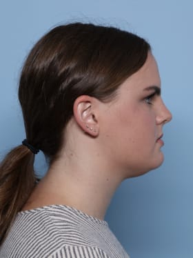 Buccal Fat Removal before - side right