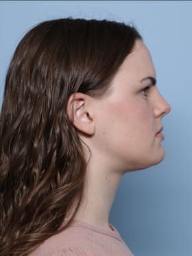 Buccal Fat Removal after - side right