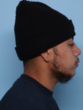Buccal Fat Removal before - side right