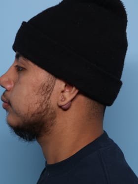 Buccal Fat Removal before - side left