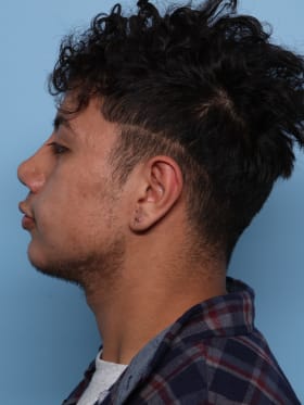 Buccal Fat Removal after - side left