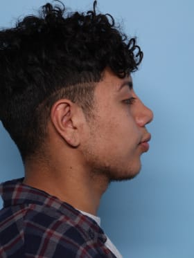 Buccal Fat Removal after - side right