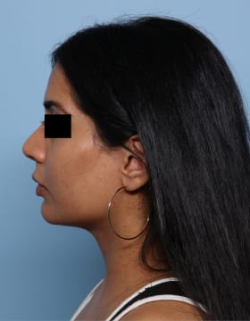 Buccal Fat Removal after - side left