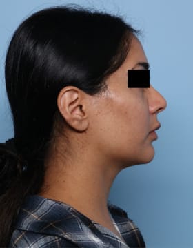 Buccal Fat Removal before - side right