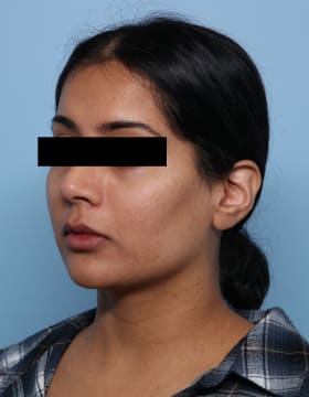 Buccal Fat Removal before - oblique left