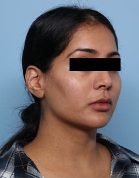 Buccal Fat Removal before - oblique right