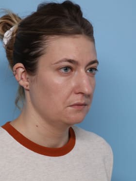Buccal Fat Removal before - oblique right
