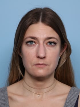 Buccal Fat Removal after - front view
