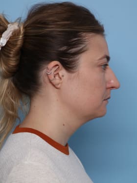 Buccal Fat Removal before - side right