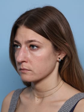 Buccal Fat Removal after - oblique left