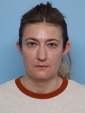 Buccal Fat Removal before - front view