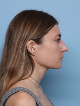 Buccal Fat Removal after - side right