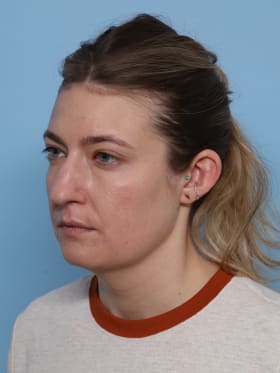 Buccal Fat Removal before - oblique left