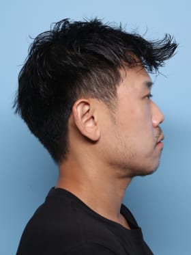 Buccal Fat Removal after - side right