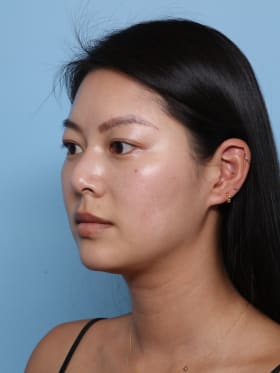 Buccal Fat Removal before - oblique left