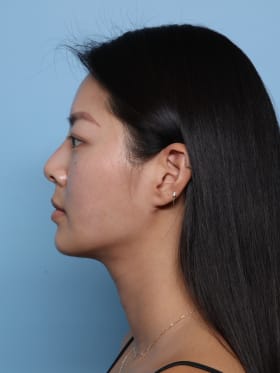 Buccal Fat Removal after - side left
