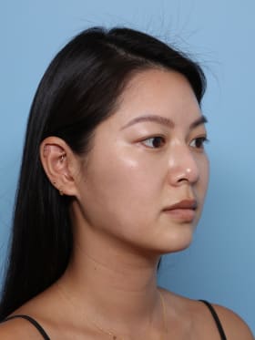 Buccal Fat Removal before - oblique right