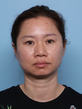 Buccal Fat Removal before - front view