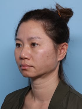 Buccal Fat Removal after - oblique left