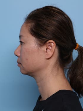Buccal Fat Removal before - side left