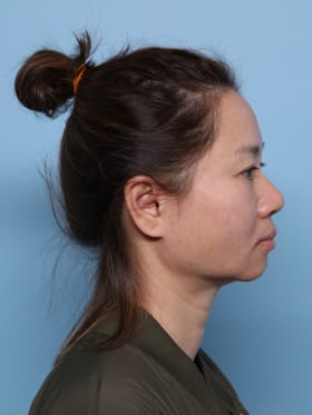 Buccal Fat Removal after - side right