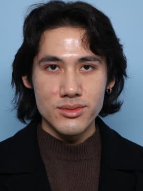 Buccal Fat Removal before - front view