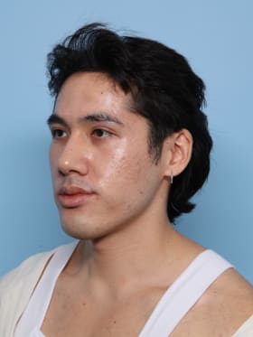 Buccal Fat Removal after - oblique left