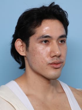 Buccal Fat Removal after - oblique right
