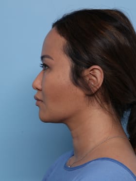 Buccal Fat Removal after - side left