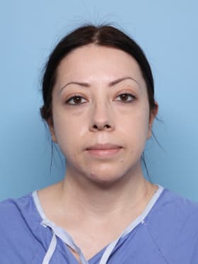 Buccal Fat Removal after - front view