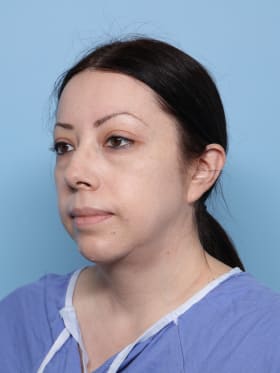 Buccal Fat Removal after - oblique left