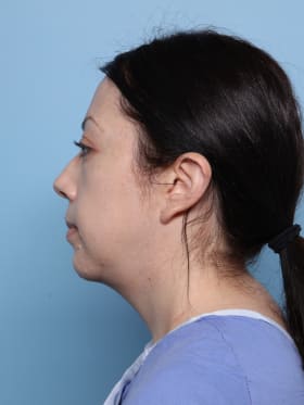 Buccal Fat Removal after - side left
