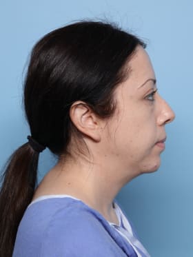 Buccal Fat Removal after - side right