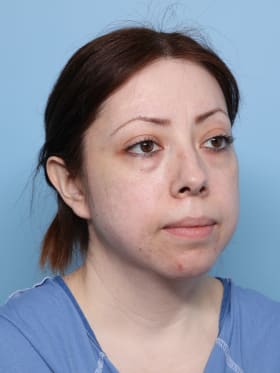 Buccal Fat Removal before - oblique right