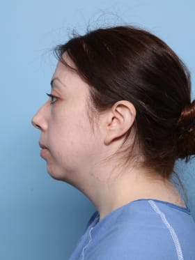 Buccal Fat Removal before - side left
