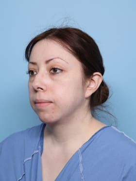 Buccal Fat Removal before - oblique left