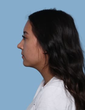Buccal Fat Removal after - side left