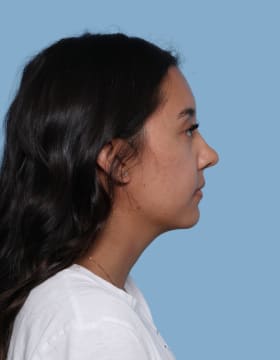 Buccal Fat Removal after - side right
