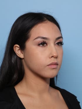 Buccal Fat Removal after - oblique right