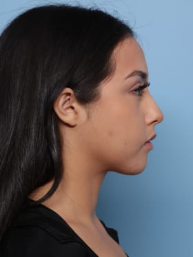 Buccal Fat Removal after - side right