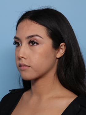 Buccal Fat Removal after - oblique left