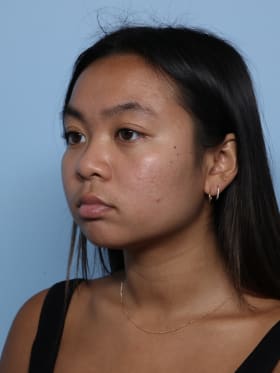 Buccal Fat Removal before - oblique left