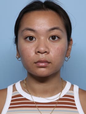 Buccal Fat Removal after - front view