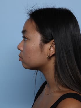 Buccal Fat Removal before - side left