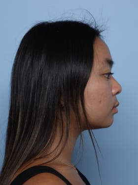 Buccal Fat Removal before - side right