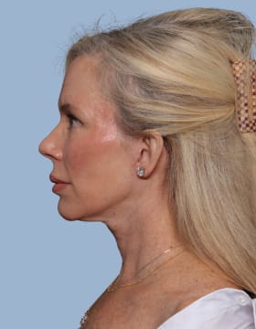 Deep Plane Facelift after - side left