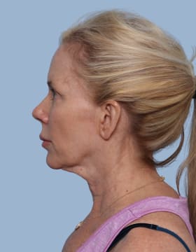 Deep Plane Facelift before - side left
