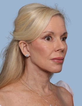 Deep Plane Facelift after - oblique right